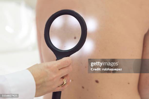 doctora examinando lunares de un paciente con una lupa - warts fotografías e imágenes de stock
