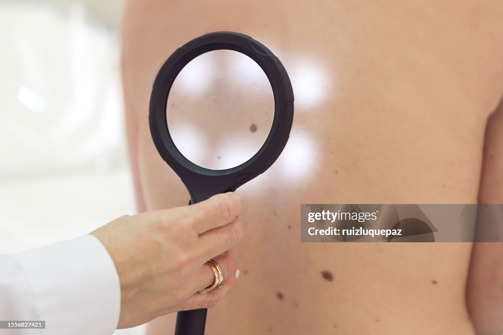 Female doctor examining moles of a patient with a magnifying glass