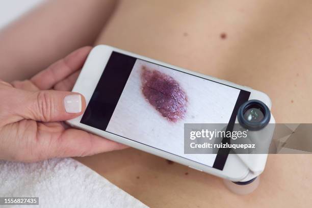 doctora examinando lunares de un paciente con lupa en un teléfono inteligente - carcinoma fotografías e imágenes de stock
