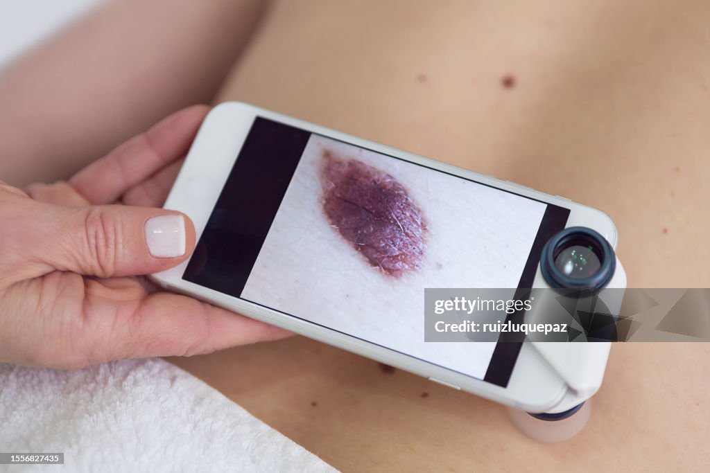 Female doctor examining moles of a patient with magnifying glass on smartphone