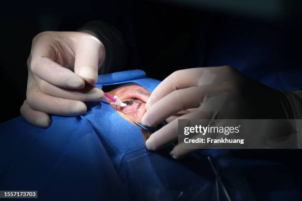 excimer laser surgery - excimer stockfoto's en -beelden