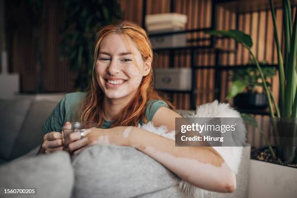 frau sitzt zu hause - vitiligo stock-fotos und bilder