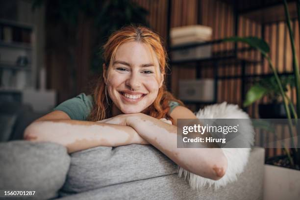 frau sitzt zu hause - depigmentierung stock-fotos und bilder