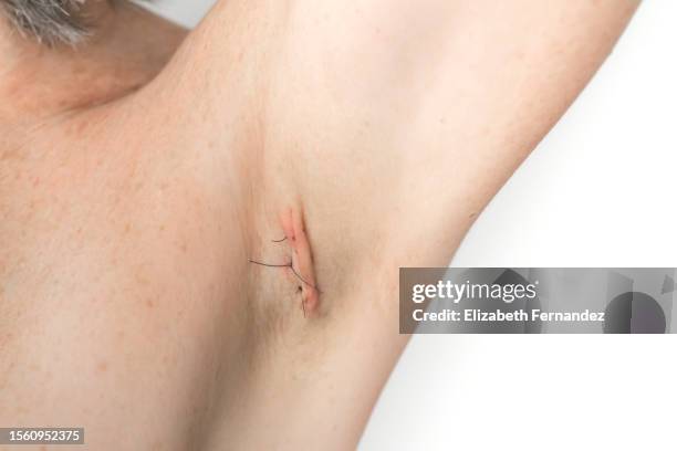 stitches on armpit after operation - unter dem arm stock-fotos und bilder
