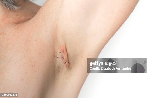 stitches on armpit after operation - hecht stockfoto's en -beelden