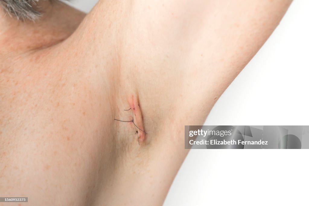 Stitches on armpit after operation