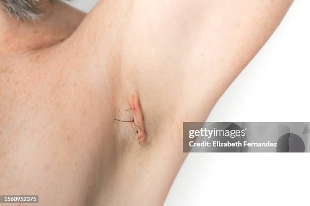 stitches on armpit after operation - suturing stock pictures, royalty-free photos & images