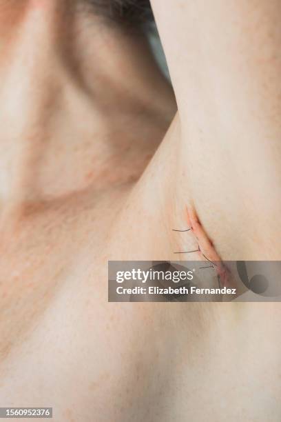 stitches on armpit after operation - sutura fotografías e imágenes de stock