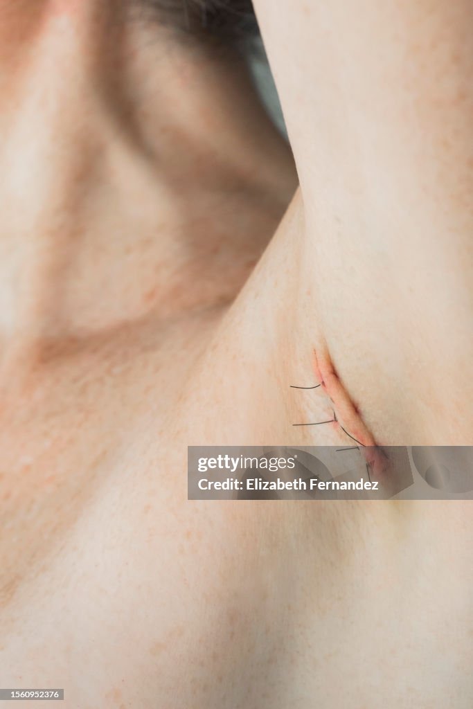 Stitches on armpit after operation