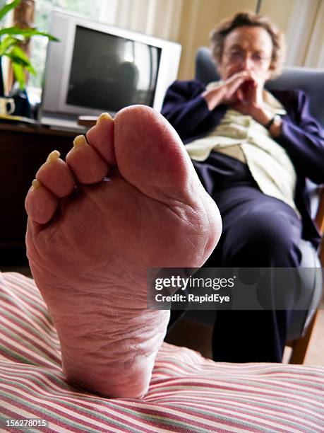 bunion with gout - old lady feet stockfoto's en -beelden