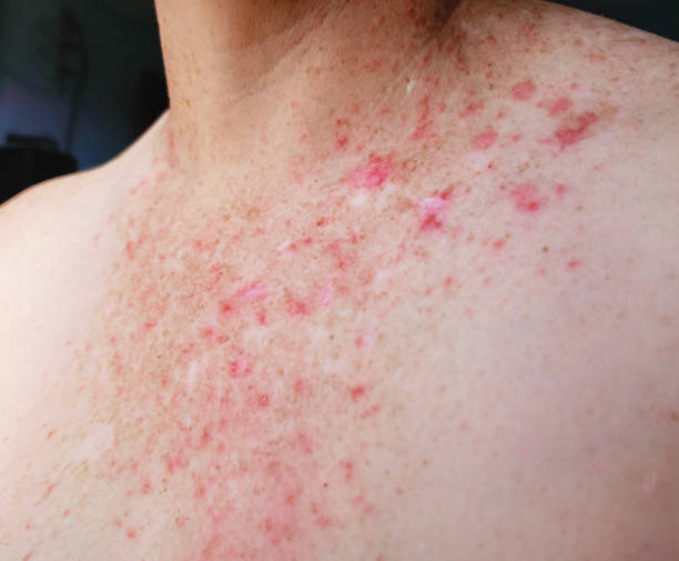 Bumpy Rash From Food 516 Food Allergy Rash Stock Photos, High-Res Pictures, and Images ...