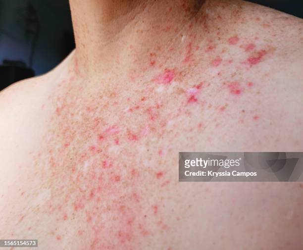 red skin rash with bumps, scabs - psoriasis skin - psoriasis stock pictures, royalty-free photos & images