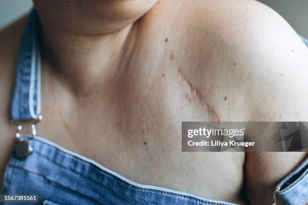close up of cancer woman with scar from port catheter for chemotherapy. - cancer scar stock pictures, royalty-free photos & images