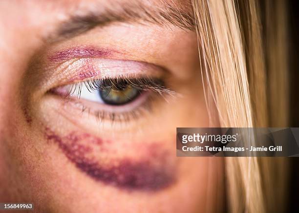 usa, new jersey, jersey city, portrait of woman with black eye - abuse stockfoto's en -beelden