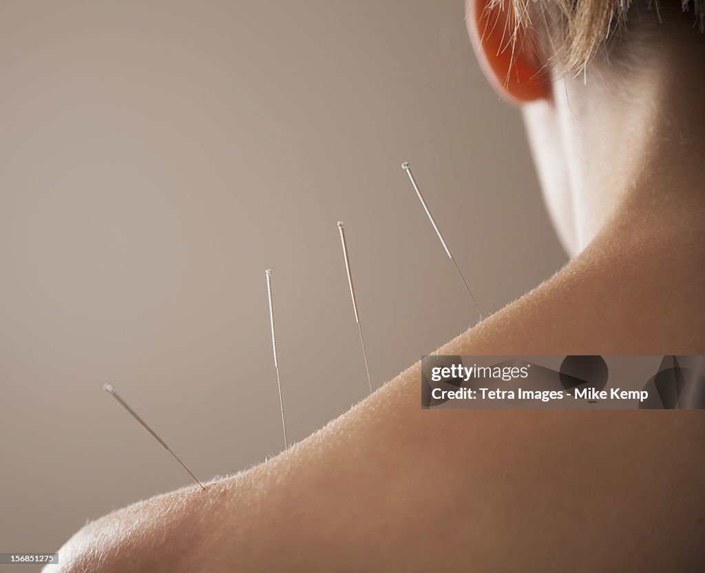 USA, Utah, Orem, Close-up of Acupuncture needles in back