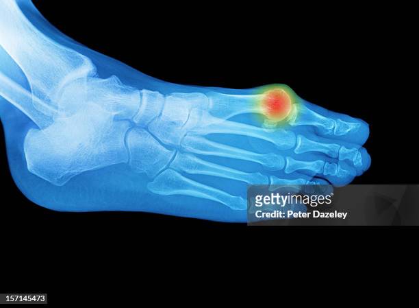 foot x-ray with an area of pain or swelling - hallux valgus 個照片及圖片檔