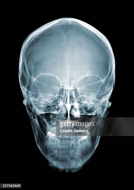 crâne xray - maxillaire humain photos et images de collection