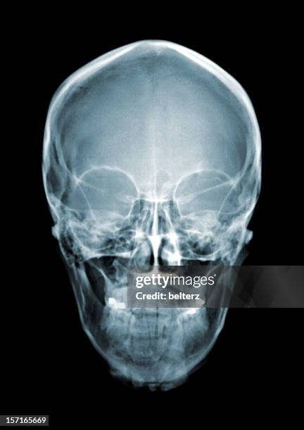 skull xray - human jaw bone stockfoto's en -beelden