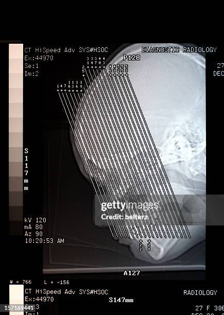 Mri Scan Sinus Machine Sinus Mri Photos and Premium High Res Pictures - Getty Images