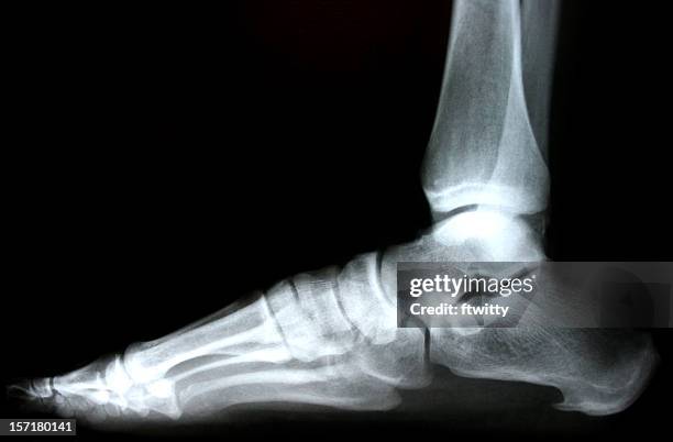 pied x-ray - broken heel photos et images de collection