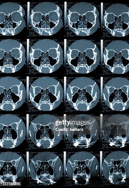 Mri Scan Sinus Machine 116 Sinus Mri Stock Photos, High-Res Pictures, and Images - Getty Images