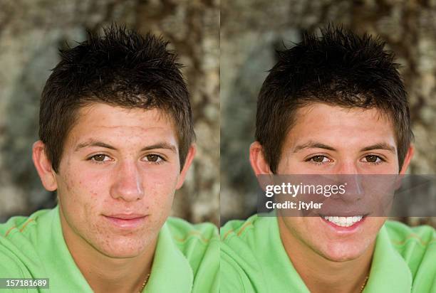 teen acne - before and after - voor en na stockfoto's en -beelden
