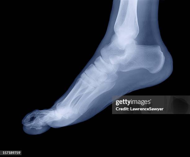 foot x-ray - xray images stock pictures, royalty-free photos & images