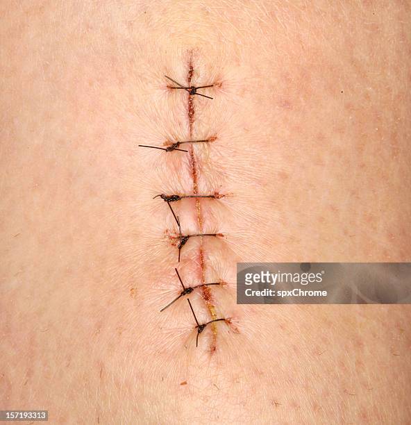 stitches - suture - fotografias e filmes do acervo