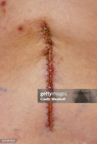 back surgery - nietje stockfoto's en -beelden