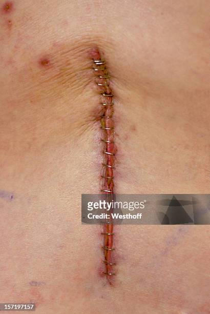 back surgery - surgery stitches stock pictures, royalty-free photos & images