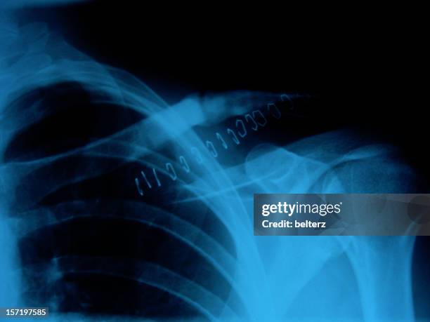 ouch x-ray - clavicle stock pictures, royalty-free photos & images