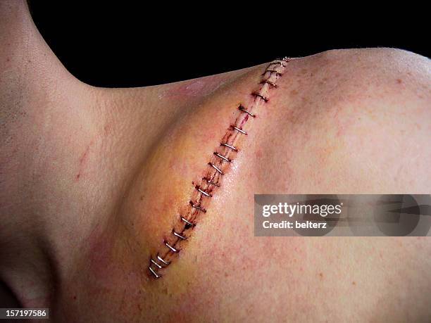 stapled wound - suture stock pictures, royalty-free photos & images