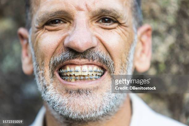 portrait of a mature man with braces, opening his mouth. concept of dentist, orthodontics, irons, treatment, smile and ugly. - ugly lips stock pictures, royalty-free photos & images