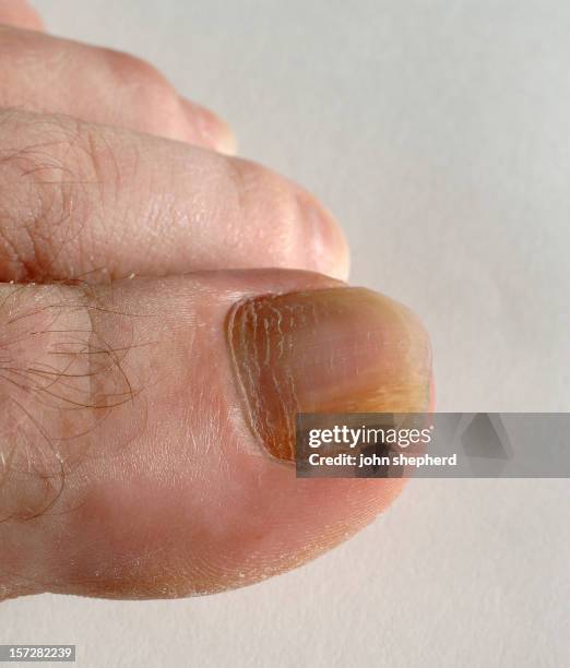 male foot with nail fungus fungi - foot fungus stock pictures, royalty-free photos & images