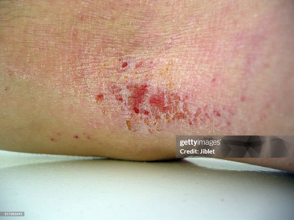 Eczema close-up