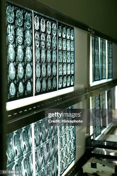 Bone Brain Scan 45 Nuclear Bone Scan Stock Photos, High-Res Pictures, and Images ...