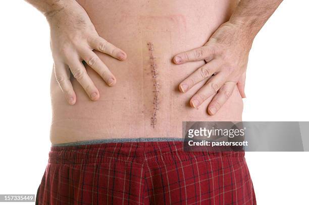 back surgery series - guy with scar stock pictures, royalty-free photos & images