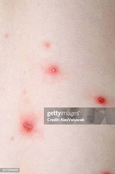135 Chickenpox Rash Stock Photos, High-Res Pictures, and Images - Getty