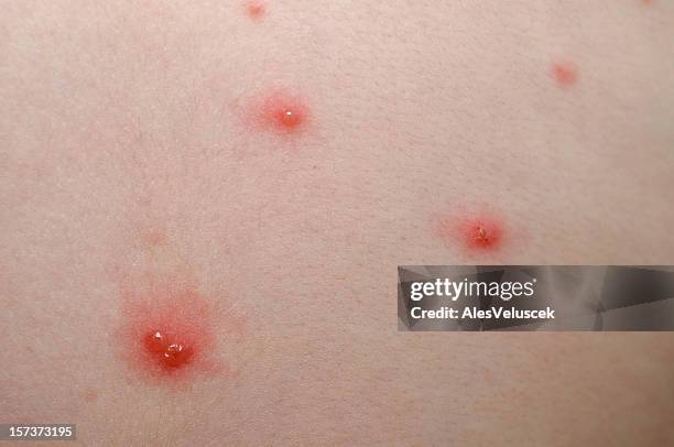 chickenpox - disease - bumpy stock pictures, royalty-free photos & images