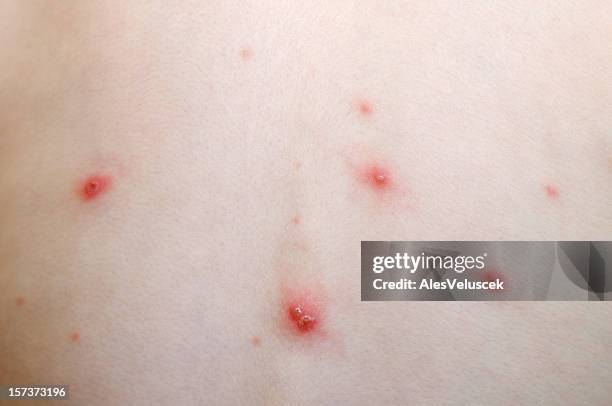 135 Chickenpox Rash Stock Photos, High-Res Pictures, and Images - Getty