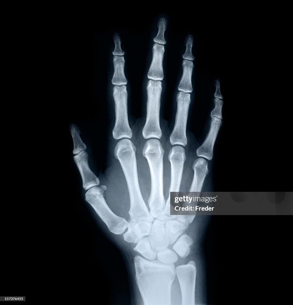 X-ray of human hand