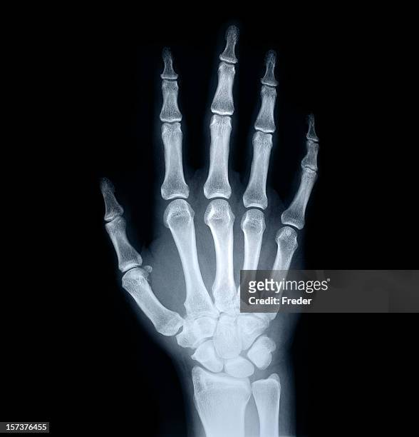 x-ray of human hand - röntgen stock-fotos und bilder