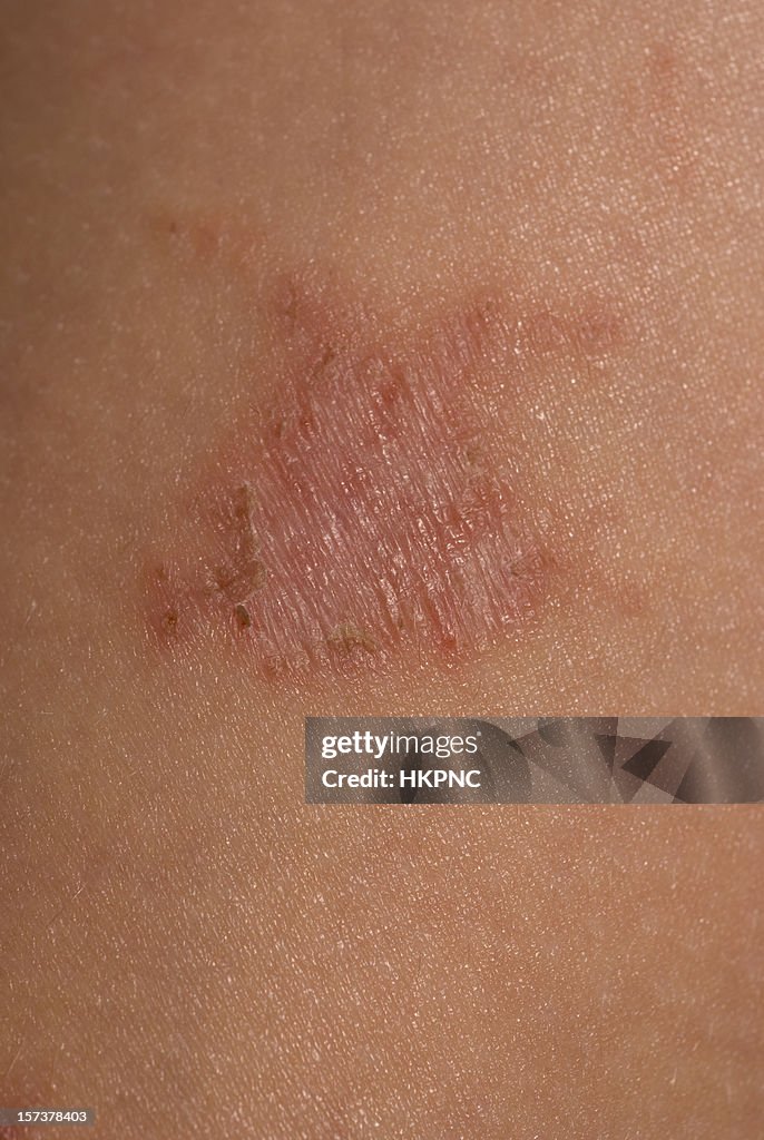 Girl Rash Child Skin With Rash High-Res Stock Photo - Getty Images