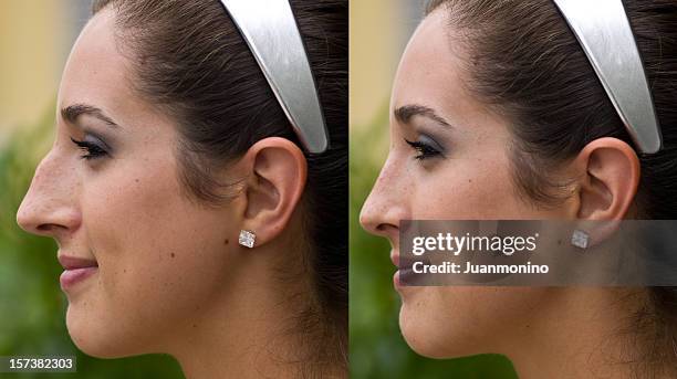 before and after plastic surgery - human nose stockfoto's en -beelden
