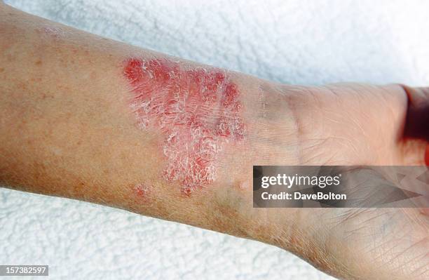 a close-up of bad psoriasis on a person's arm - huidaandoening stockfoto's en -beelden