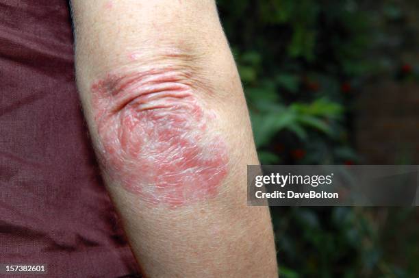 psoriasis - psoriasis skin stock pictures, royalty-free photos & images