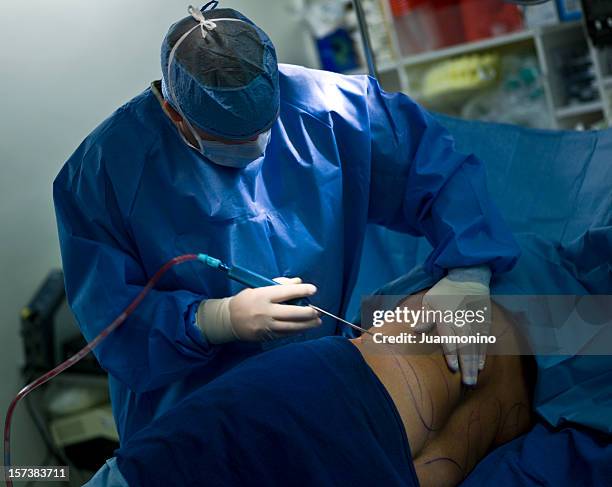 liposuction - liposuction stock pictures, royalty-free photos & images