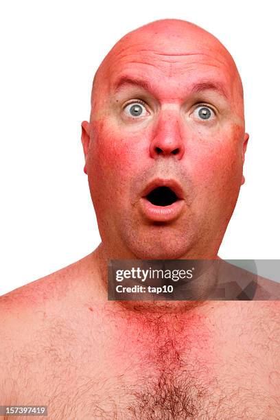 sun burn - burnt man stock pictures, royalty-free photos & images