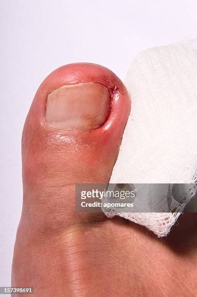 ingrown toenail - abscess stockfoto's en -beelden