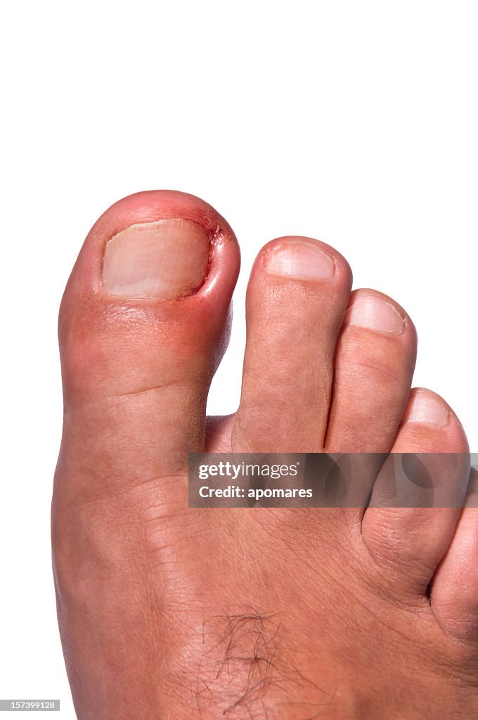 Ingrown Toenail